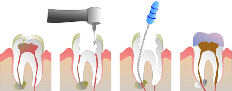 Root canal treatment in paschim vihar, West Delhi, Paschim Vihar, Root canal treatment